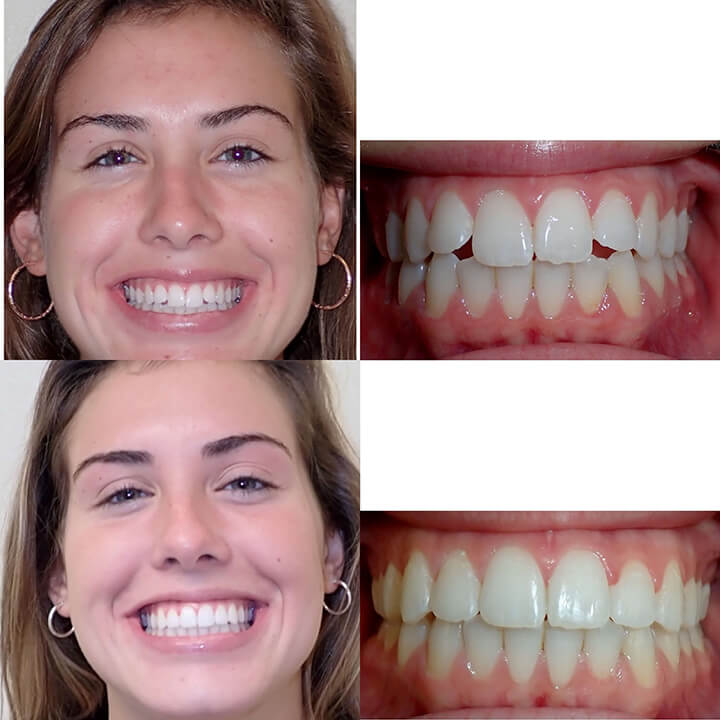 Before & After Invisalign