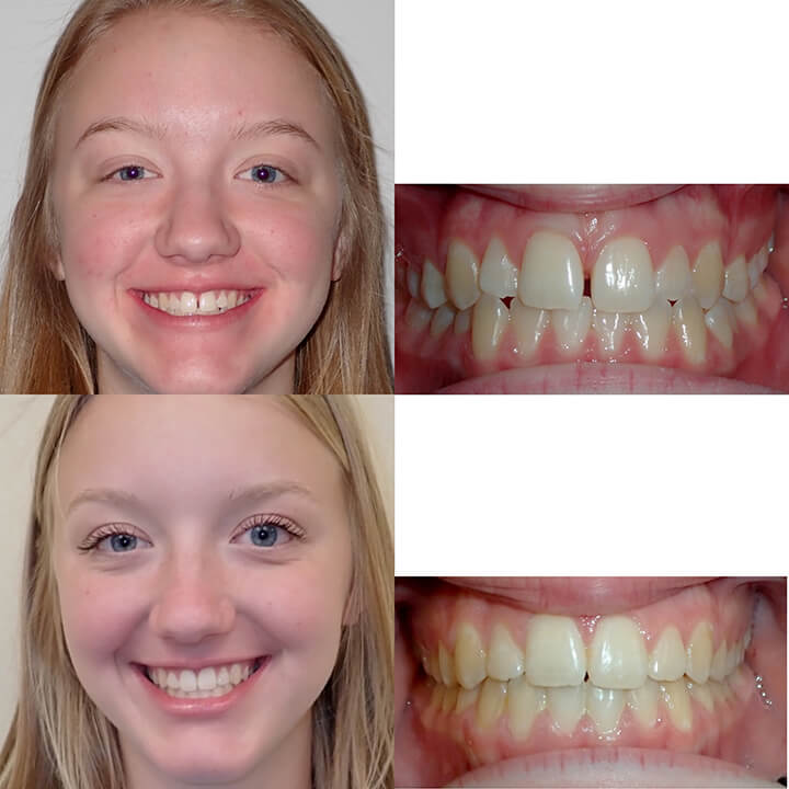 before and after braces adults