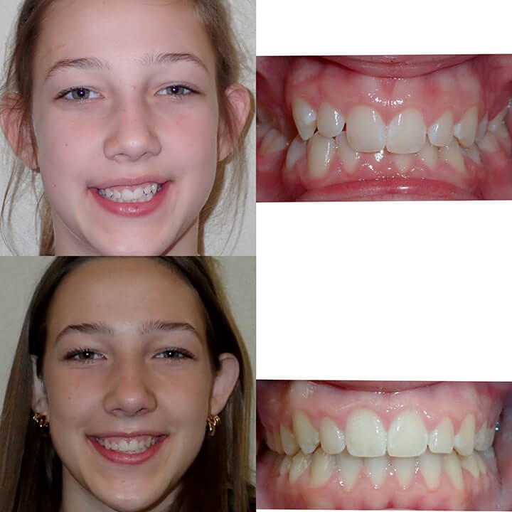 before and after braces adults