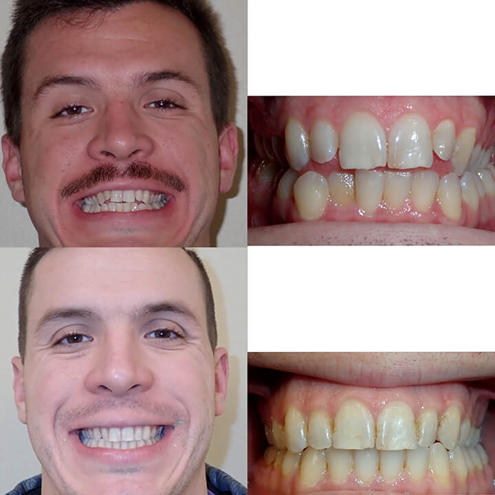 Adult Braces Before And After