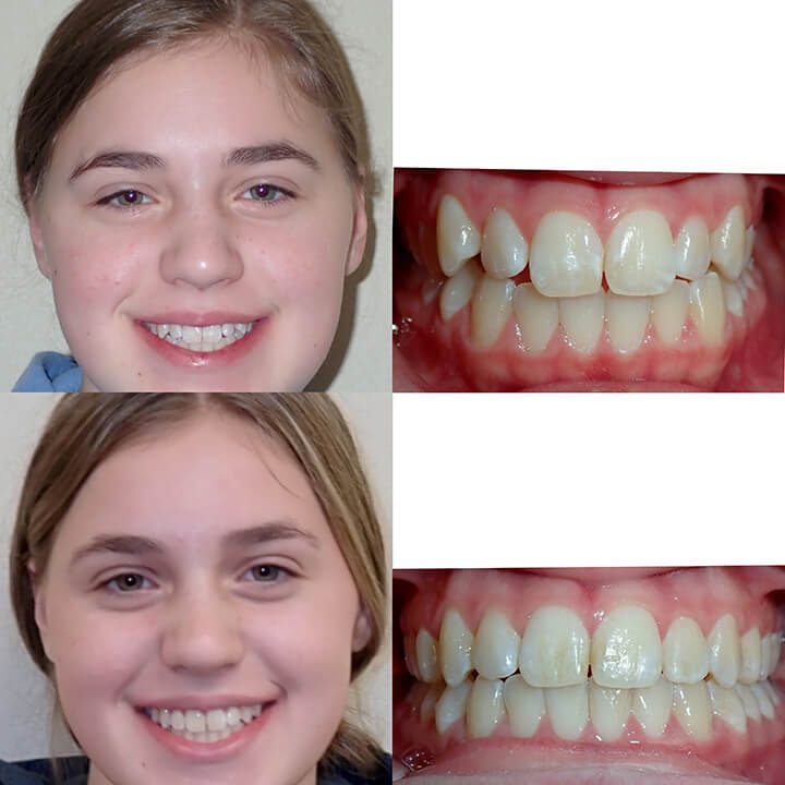 Invisalign_Teen,_crowding-021323.jpg