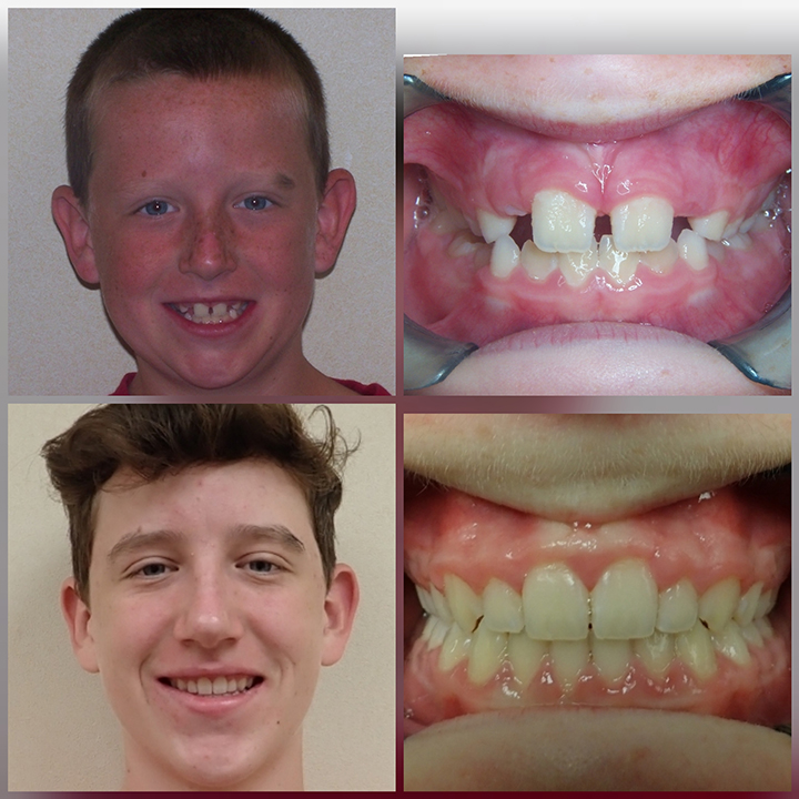 before and after