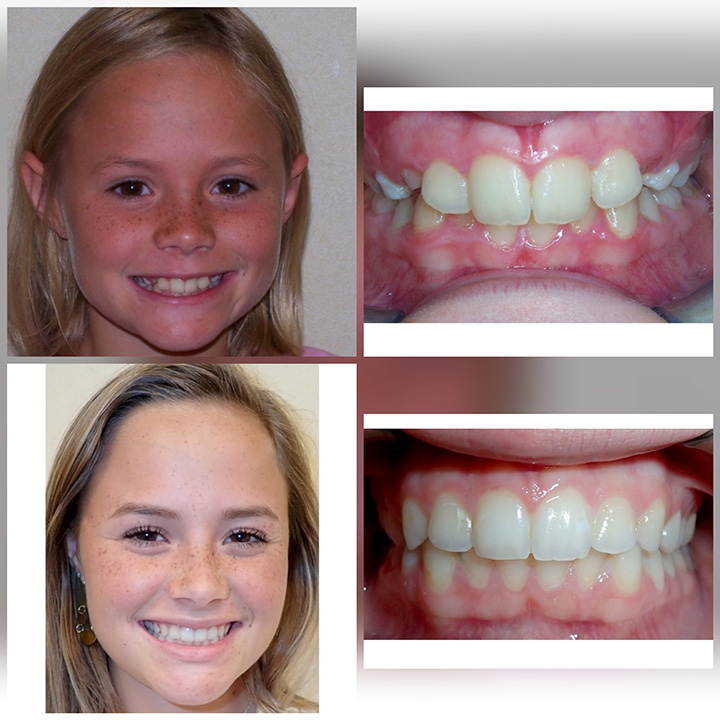 Before & After Braces | Wazio Orthodontics Before & After Braces | Wazio Orthodontics