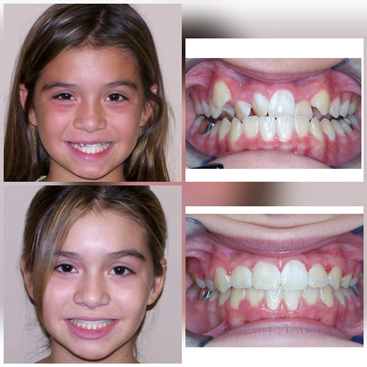 Before And After Braces Wazio Orthodontics