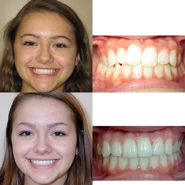 Before And After Braces Wazio Orthodontics