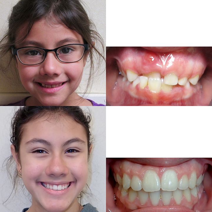 Before And After Braces Wazio Orthodontics