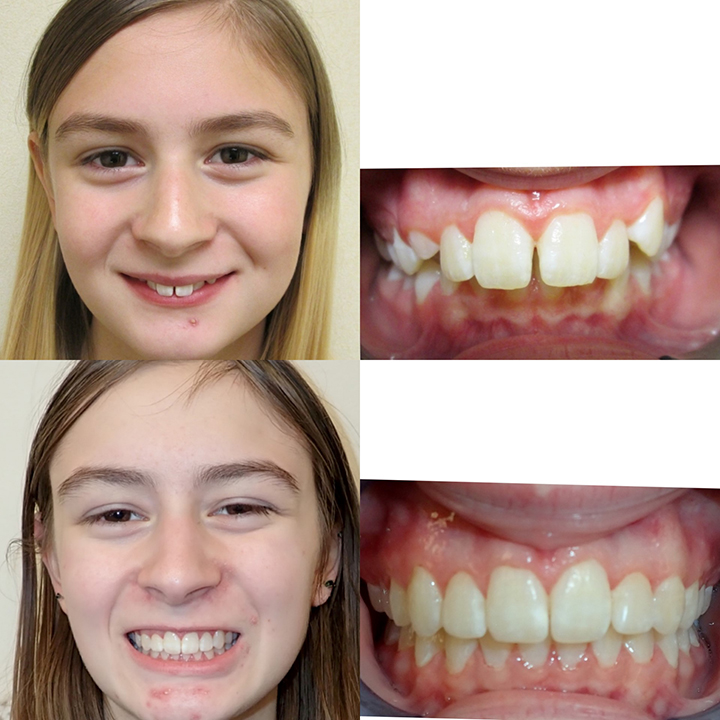 overbite before and after