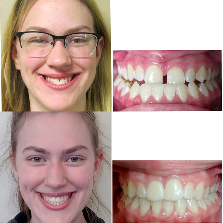 before and after braces adults