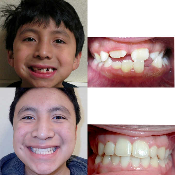 overbite before and after